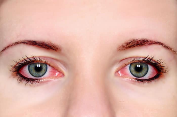 Penyebab Umum Kondisi Mata Ini Yang  Sering Terjadi
