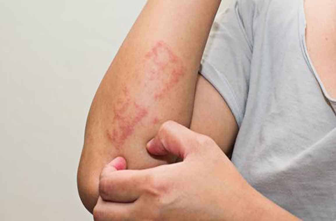 Dermatitis Kontak Alergi - Jenis Alergi Kulit