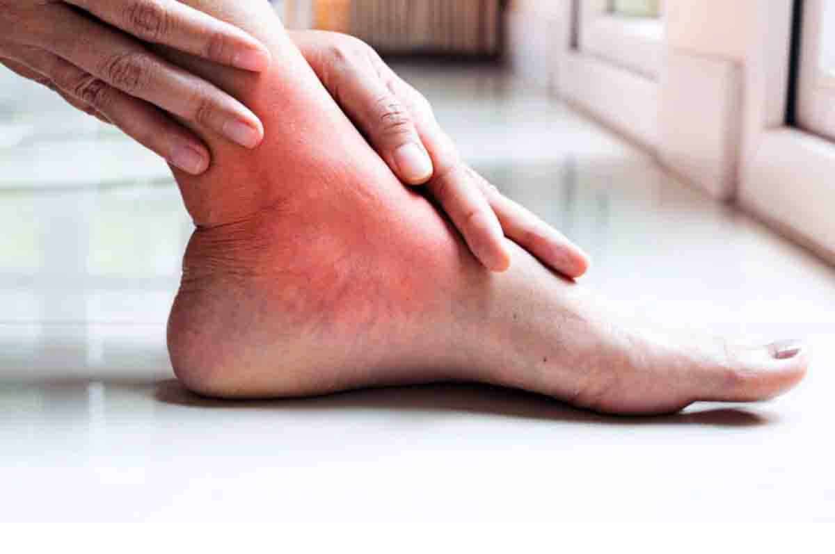 Bursitis - Tumit kaki sakit dipijakkan karena peradangan pada bursa