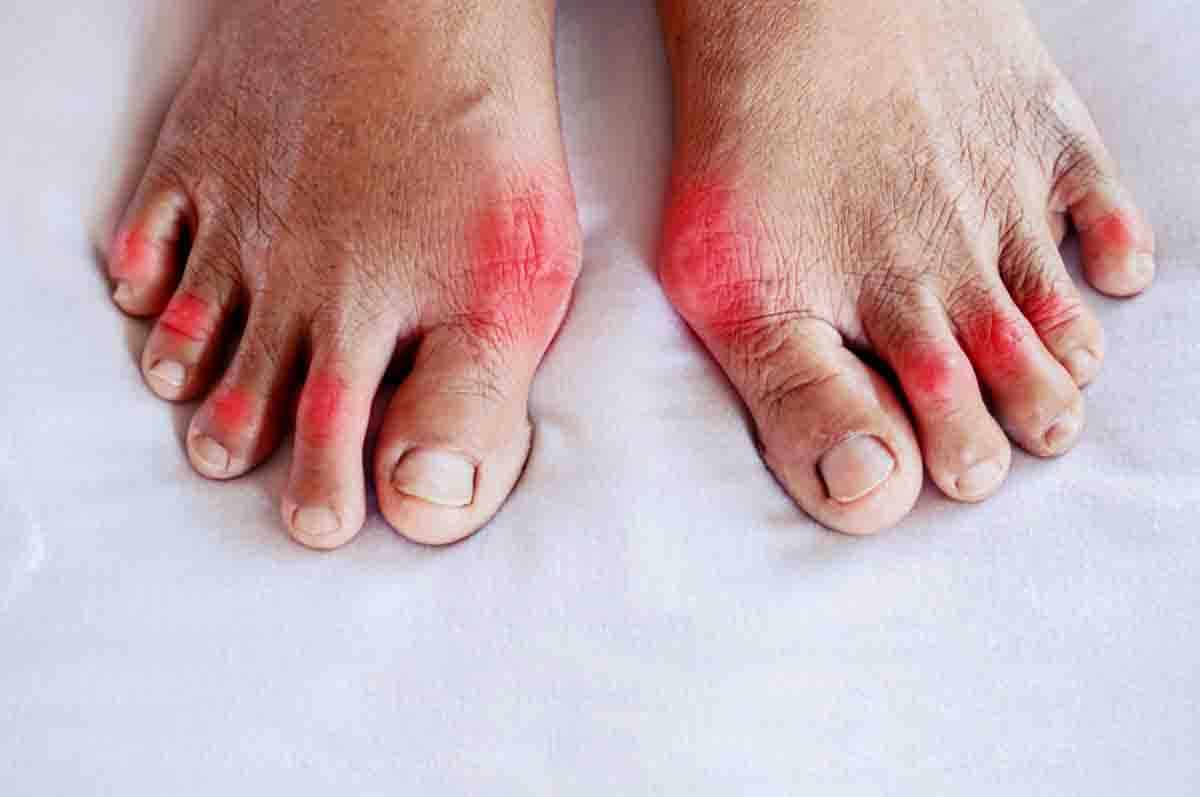 Rheumatoid Arthritis - Tumit kaki sakit dipijakkan karena peradangan sendi