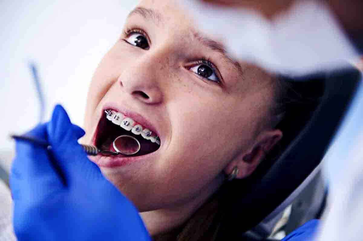 Pemasangan Kawat Gigi - Fakta tentang gigi susu lepas usia berapa dan tindakan medis yang mengikutinya