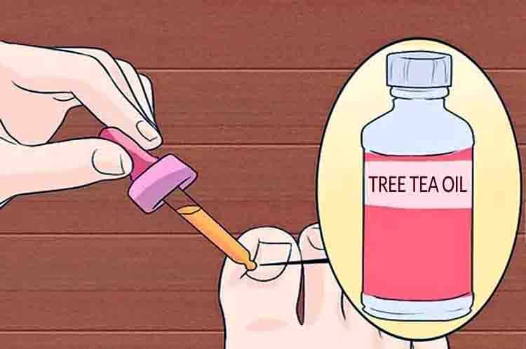 Manfaatkan Tree Tea Oil - Sembuhkan bengkak cantengan