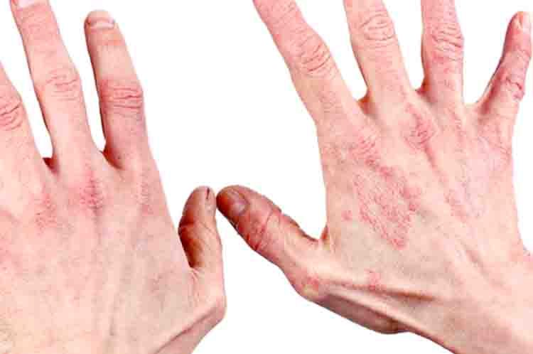 Penyakit Autoimun - Berapa lama kelenjar getah bening mengecil yang disebabkan oleh penyakit autoimun