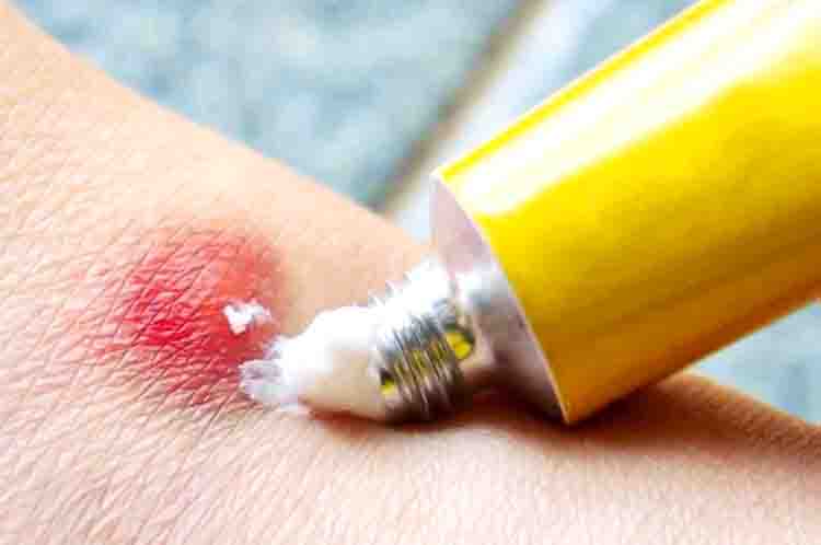 Memakai Obat OTC - Tips hilangkan bekas gigitan nyamuk yang sudah menghitam adalah dengan memakai obat OTC