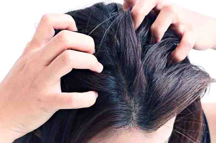 Biduran - Kulit kepala gatal tanpa sebab merupakan salah satu gejala dari terjadinya penyakit Biduran